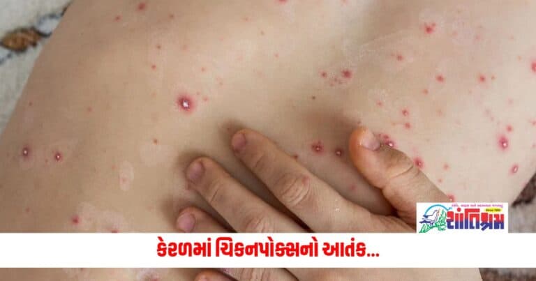 Chickenpox In Kerala: કેરળમાં ચિકનપોક્સનો આતંક, નોંધાયા 6 હજારથી વધુ કેસ