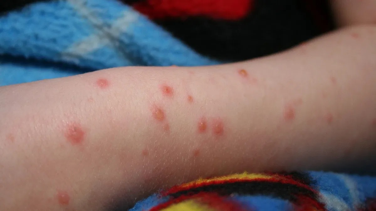 Chickenpox In Kerala: કેરળમાં ચિકનપોક્સનો આતંક, નોંધાયા 6 હજારથી વધુ કેસ