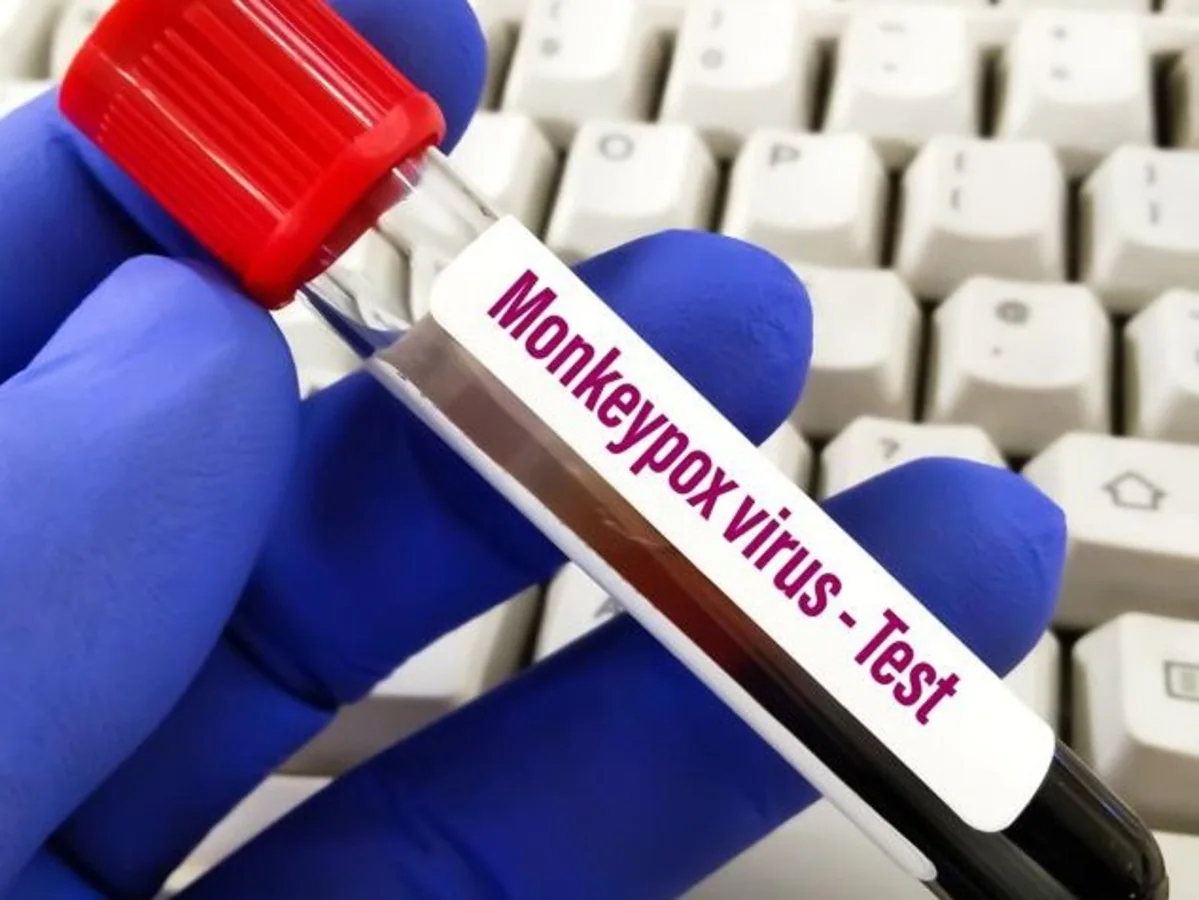 Monkeypox Virus : પાકિસ્તાનમાં પણ MPox કેસ મળ્યો, વ્યક્તિ સાઉદી અરેબિયાથી પરત ફર્યો હતો