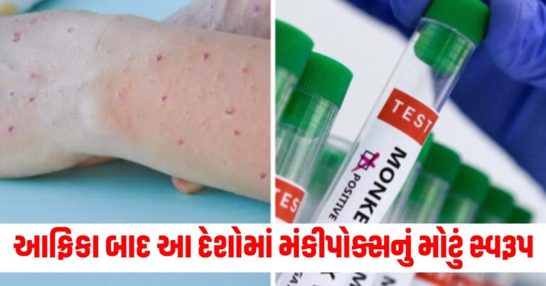 Monkeypox , News in Gujarati, Monkeypox vaccine, infectious disease,